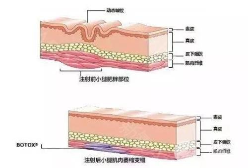 注射瘦腿果