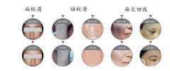 黑脸娃娃嫩肤疼吗？黑脸娃娃嫩肤注意事项有哪些？
