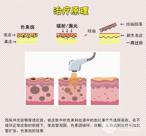 彩光祛斑会反弹吗