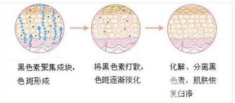 激光祛斑疼不疼