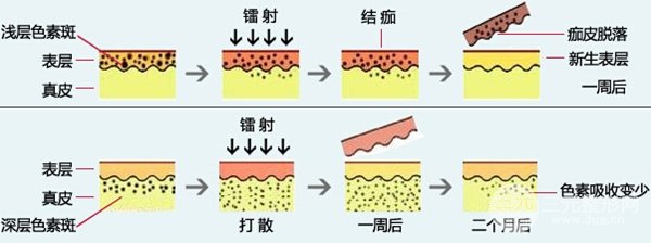 激光祛斑疼不疼