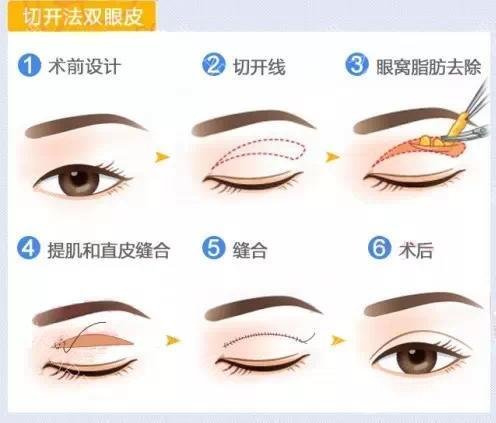 上睑松弛整形术