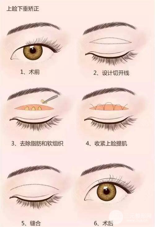 上睑松弛整形术