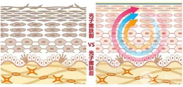 光子嫩肤美白成好吗