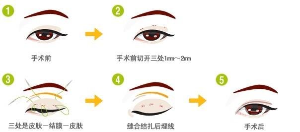 微创定点定位双眼皮贵吗