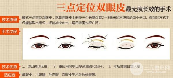 微创定点定位双眼皮贵吗