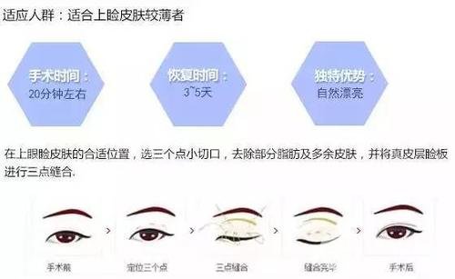 微创定点定位双眼皮贵吗