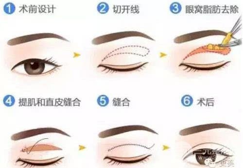 微创定点定位双眼皮贵吗