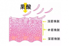 果酸嫩肤是怎么做的？术后防止复发你得注意这7点