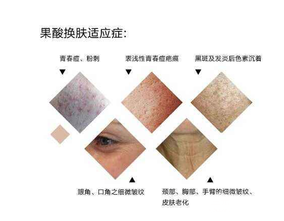 果酸嫩肤是怎么做的