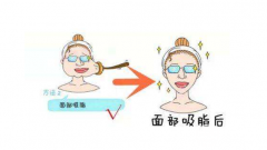 吸脂瘦脸手术术后一定要注意这些，别说我没告诉你！