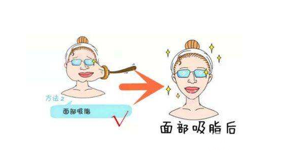 吸脂瘦脸手术术后一定要注意这些，别说我没告诉你！