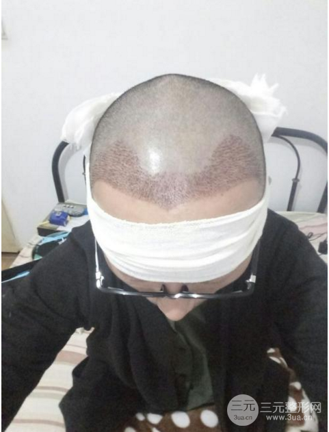 秃顶能植发吗
