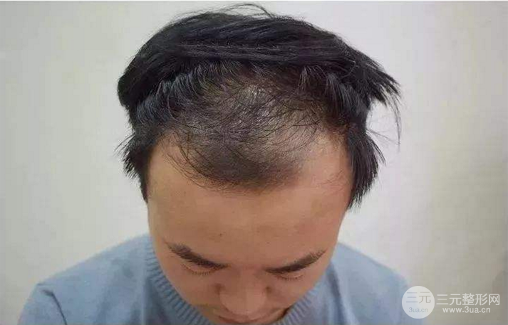 秃顶能植发吗