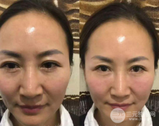 微创去眼袋手术怎么样？4种方法赶走你的大眼袋！