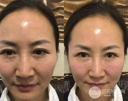 微创去眼袋手术