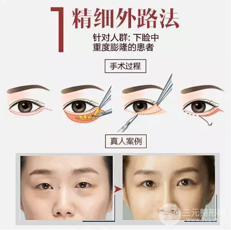 微创去眼袋手术