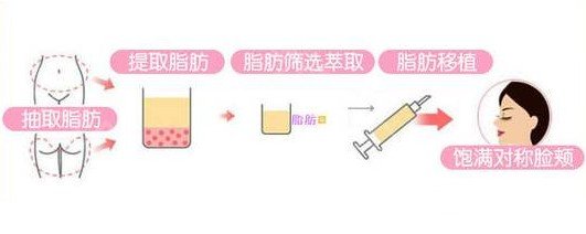 svf脂肪胶填充技术果图