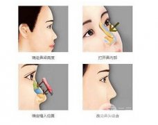 [科普]韩式自体软骨隆鼻概念、果、价格全解