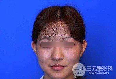 削骨瘦脸价格多少