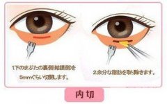 内切去眼袋几天恢复?从一周到一个月你是哪种?