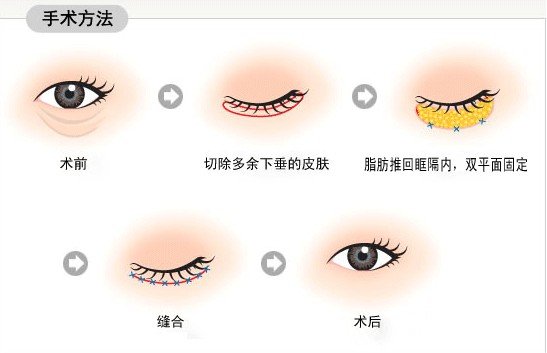 内切去眼袋几天恢复