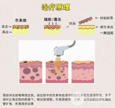 医院彩光美白嫩肤多少钱