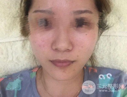 医院彩光美白嫩肤多少钱