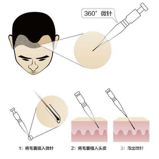 种植头发原理