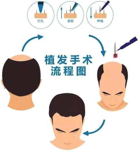 种植头发