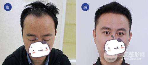 种植头发果图