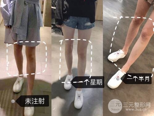 注射瘦腿果图