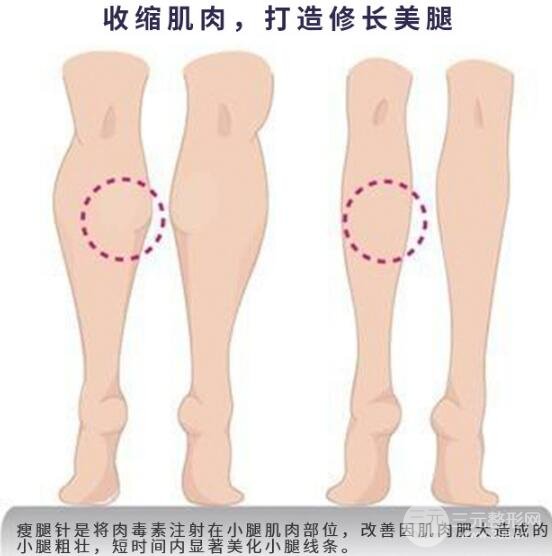 注射瘦腿原理