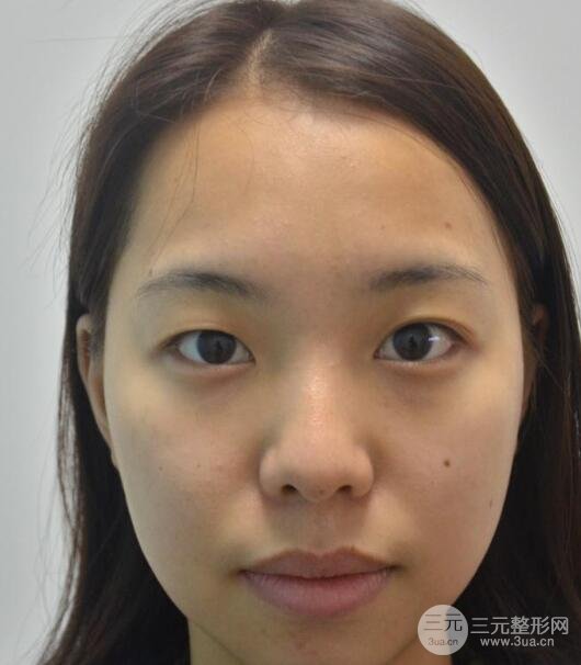 双眼皮案例