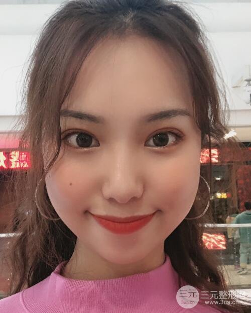 双眼皮案例