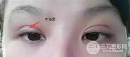 双眼皮肉条多久能消?