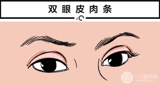双眼皮肉条多久能消?