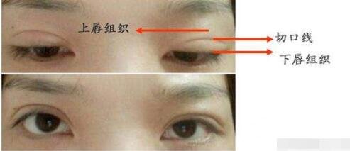 双眼皮手术后的护理也较为重要