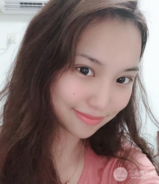 双眼皮案例