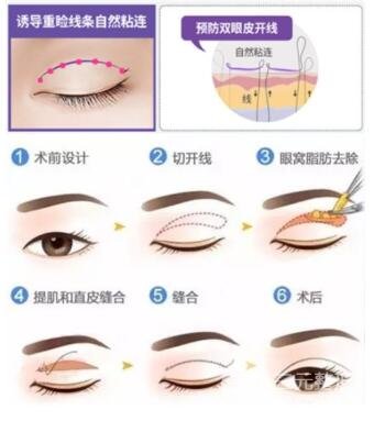 双眼皮手术的方式都有哪一些?