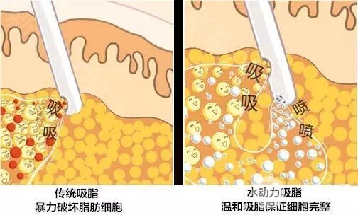 水动力吸脂和360环吸的区别
