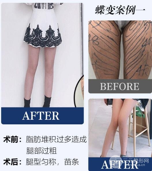吸脂果图