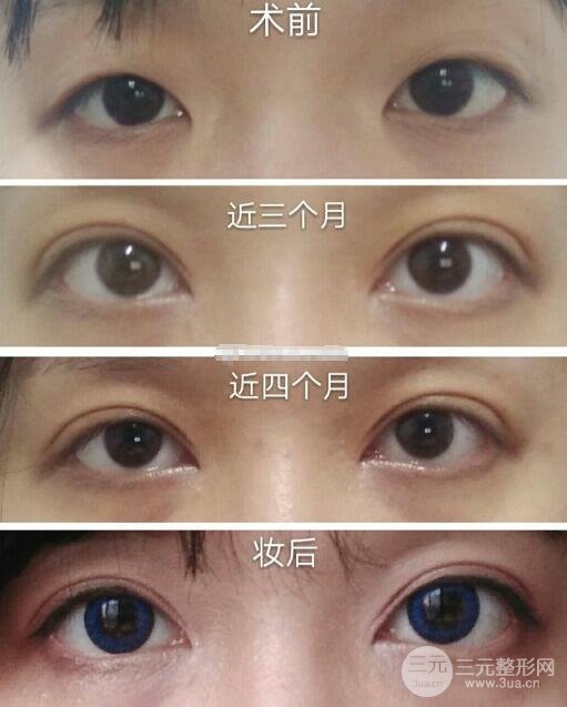 手术后的注意事项
