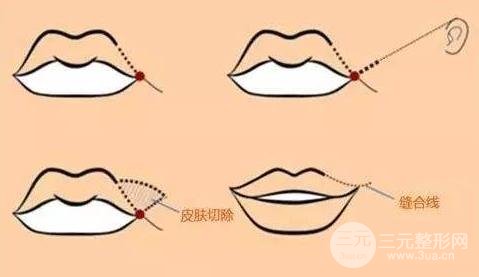 m唇手术步骤图片多少钱?手术步骤解析及手术注意事项~