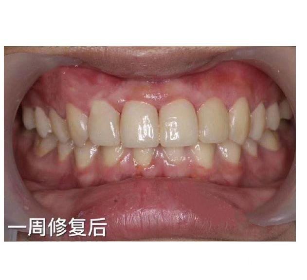 青岛口腔医院价目表是怎样的？医生团队&烤瓷牙案例分享~
