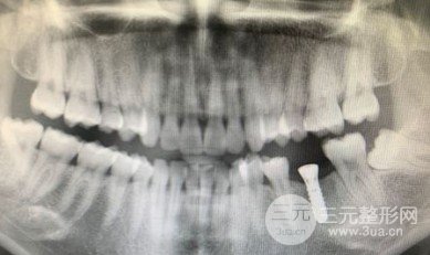 龙岗第七人民医院口腔科价格表