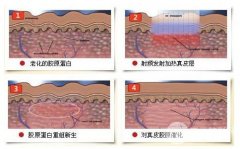 激光缓解黑眼圈有没有副作用?天生黑眼圈亲测有!