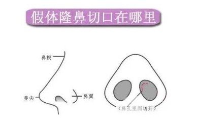 隆鼻手术切口图解