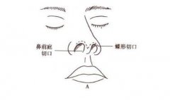 隆鼻手术切口图解,看看示意图一目了然! 隆鼻手术切口图解,看看示意图一目了然!