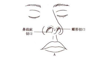 隆鼻手术切口图解